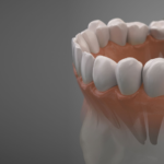 Implant in Agoura Hills