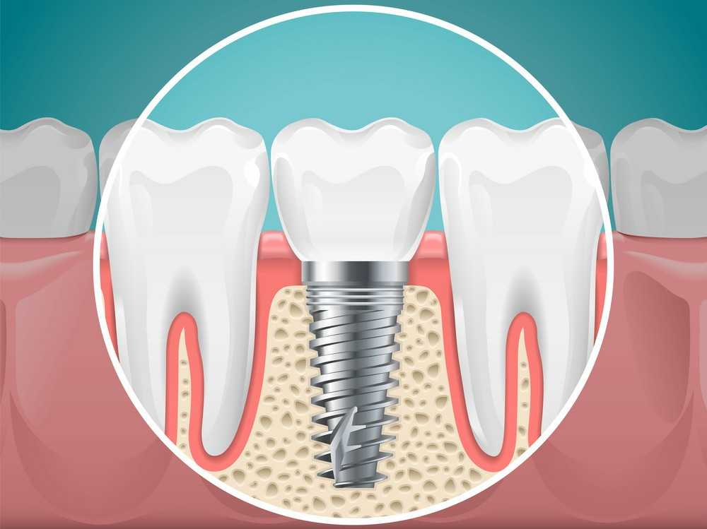 Implants